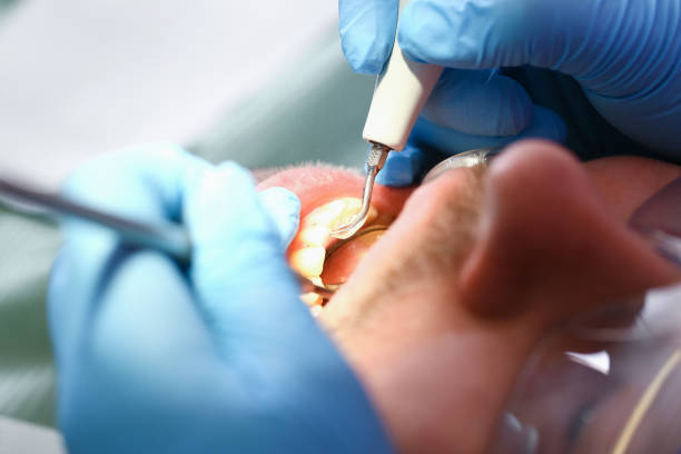 Best Emergency Wisdom Tooth Extraction in Dinuba, CA