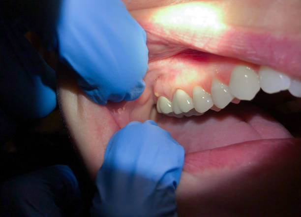 Best Knocked-Out Tooth (Avulsed Tooth) Treatment in Dinuba, CA